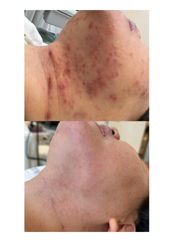 面部痤疮肤质修护记录