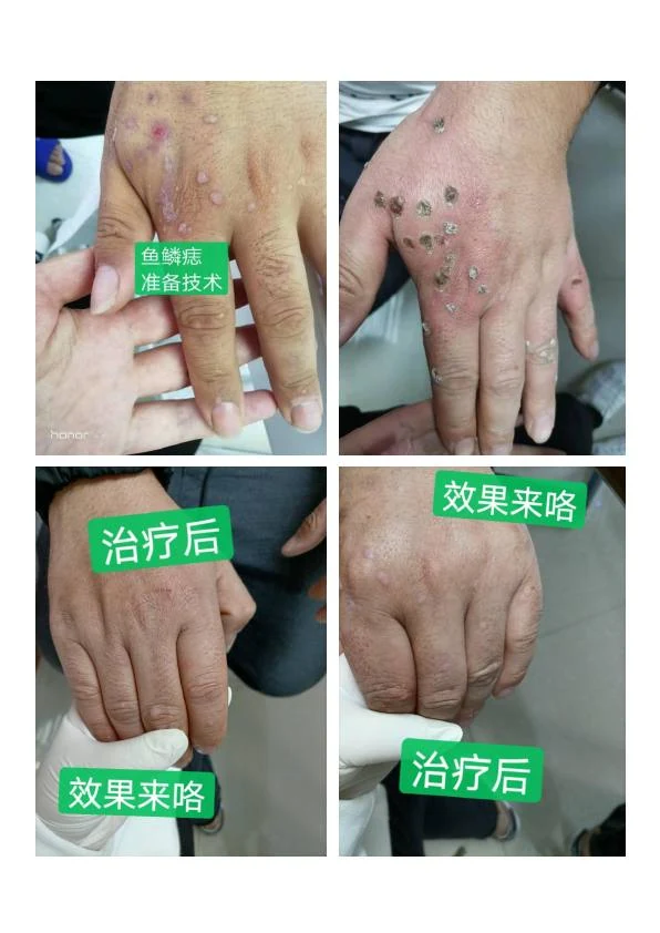 面部色素痣改善记录二