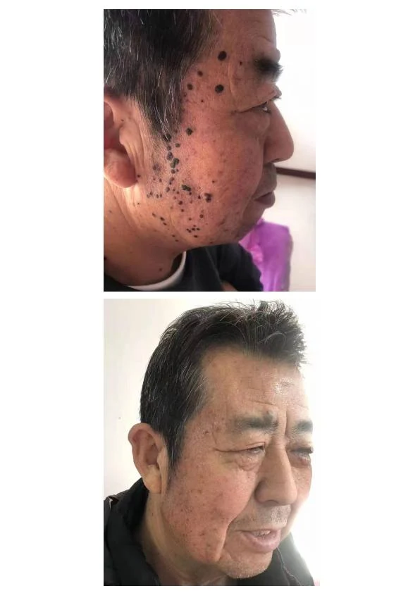 面颊色素痣改善记录