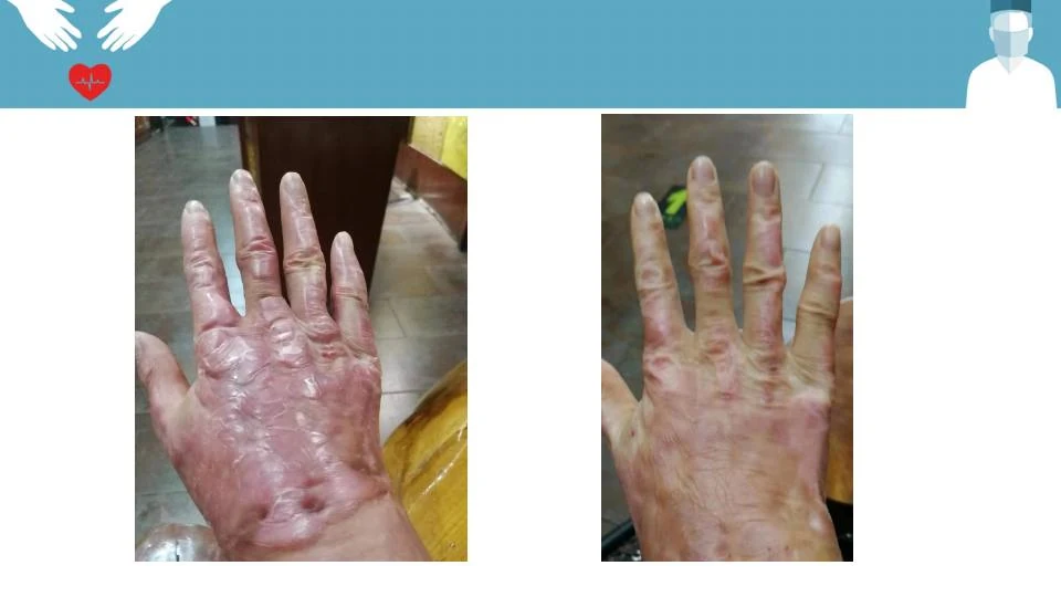 手部疤痕修复阶段对比