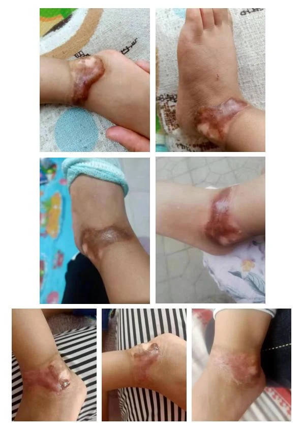 四肢增生疤改善记录