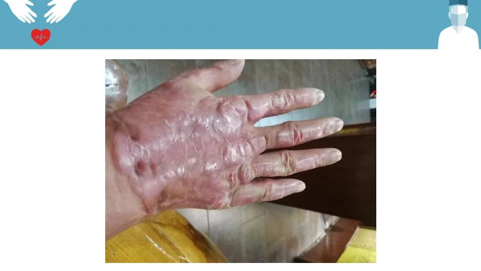 手掌疤痕肤质改善记录
