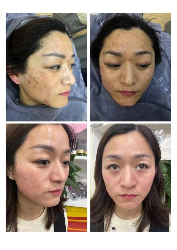 面部敏感屏障改善记录