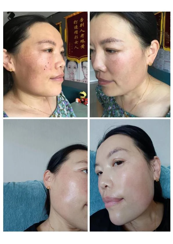 面颊黄褐斑淡化记录
