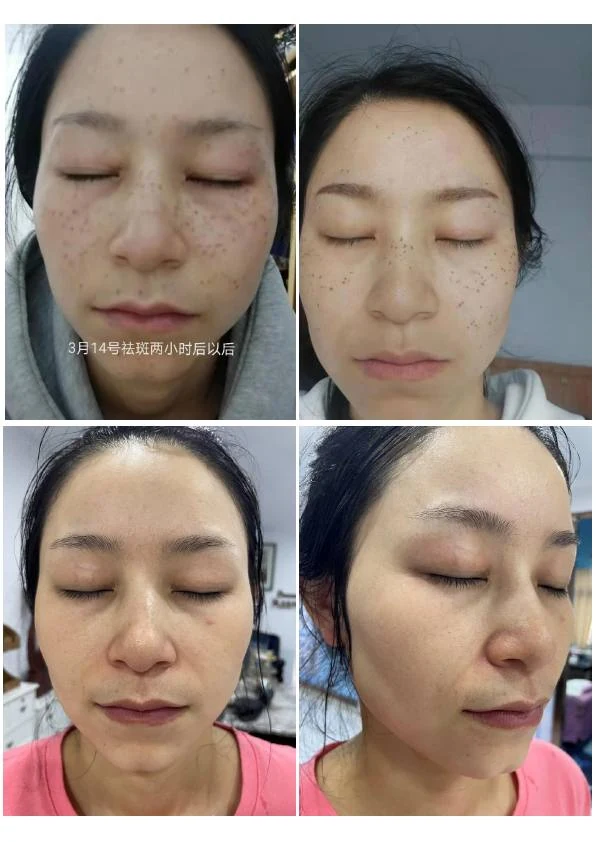 面部雀斑综合管理记录