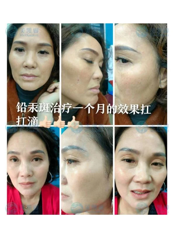 面颊铅汞斑改善对比