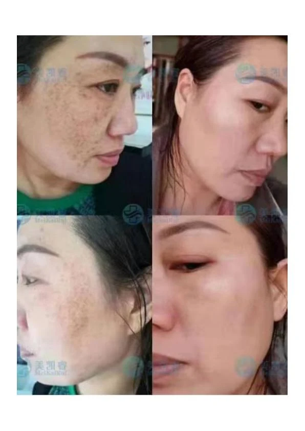 面部色素沉着改善对比
