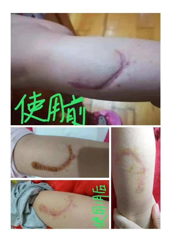 凹陷疤改善阶段记录 12