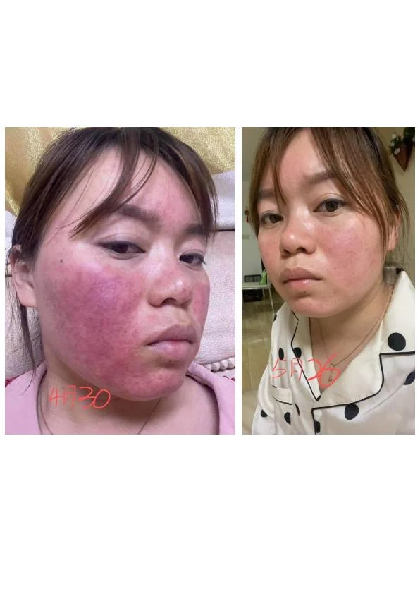 敏感泛红修护阶段记录 04