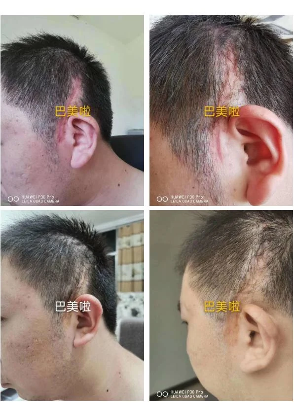 凹陷疤改善阶段记录 06