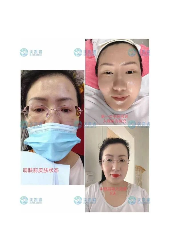 黄褐斑淡化阶段记录 05