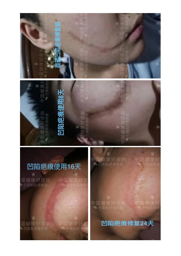 凹陷疤改善阶段记录 03