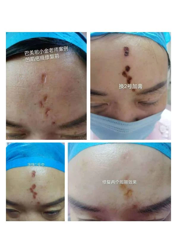 凹陷疤改善阶段记录 02