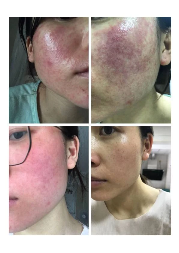 敏感泛红修护阶段记录 05