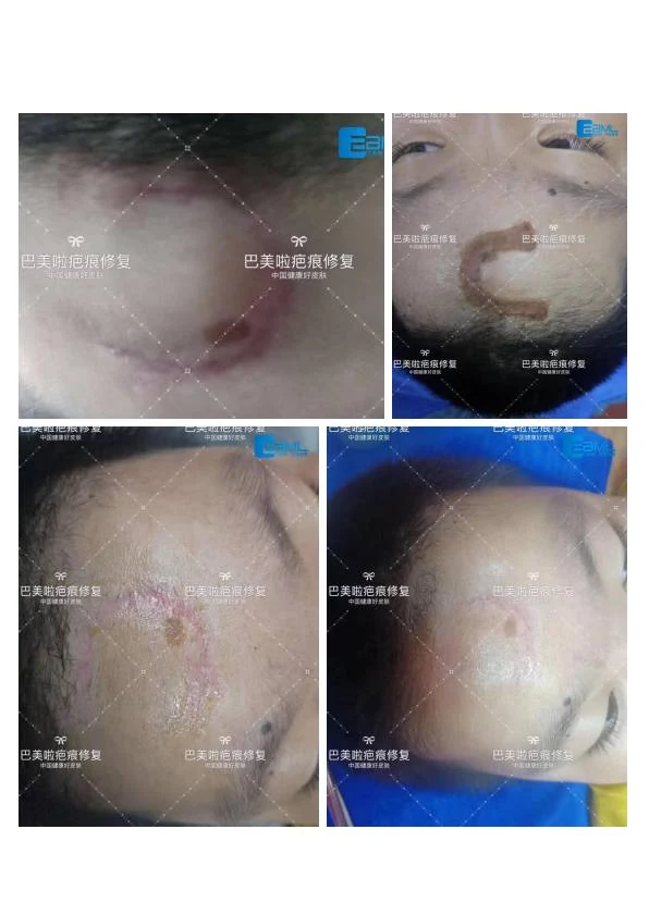 凹陷疤改善阶段记录 08