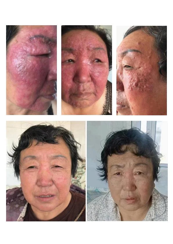 敏感泛红修护阶段记录 03