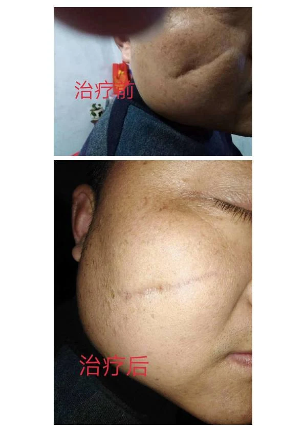 凹陷疤改善阶段记录 09