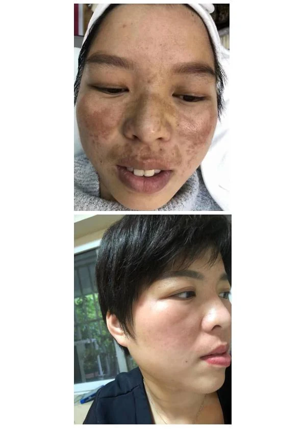 黄褐斑淡化阶段记录 03