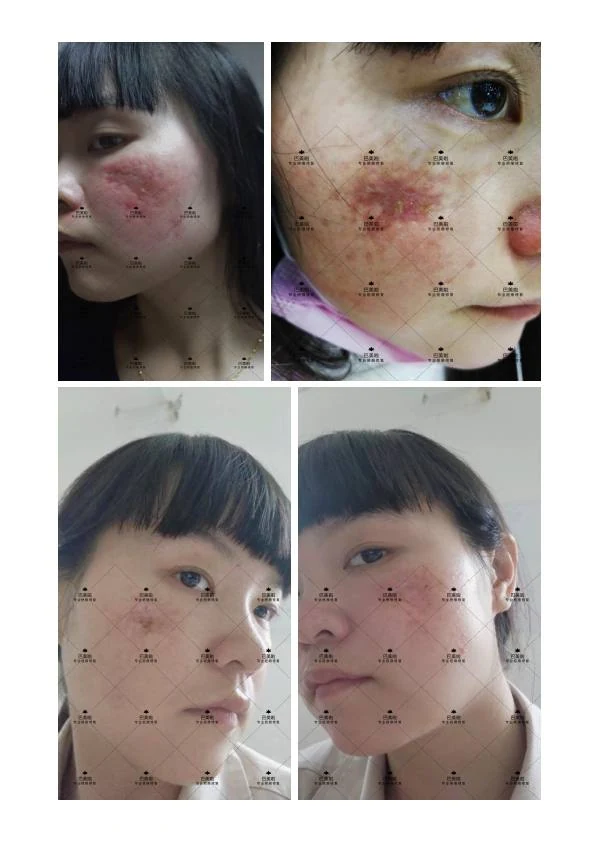 凹陷疤改善阶段记录 11
