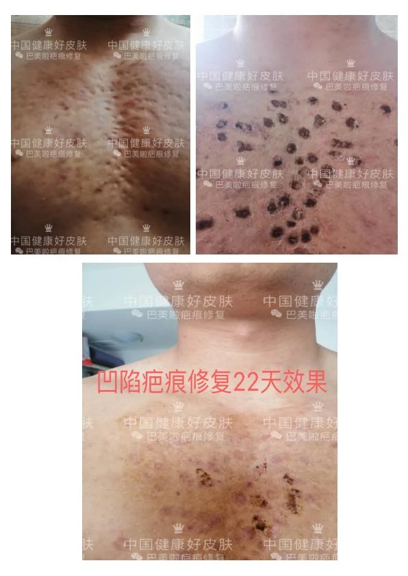 凹陷疤改善阶段记录 10