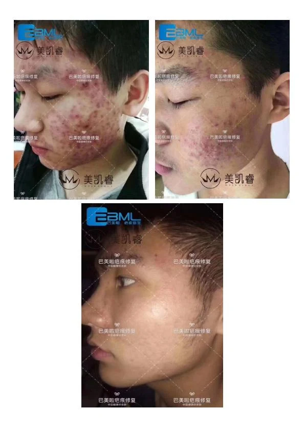 敏感泛红修护阶段记录 01