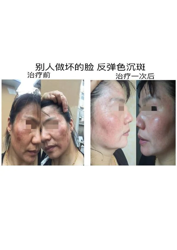 色素沉着改善阶段记录 03