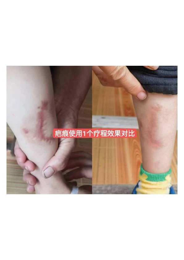 增生疤修复阶段记录 02