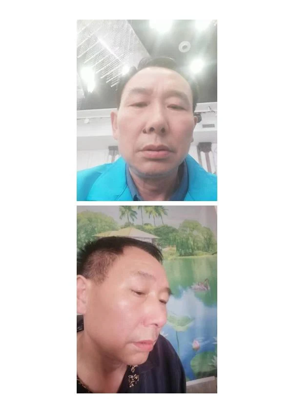 色素痣改善阶段记录 03