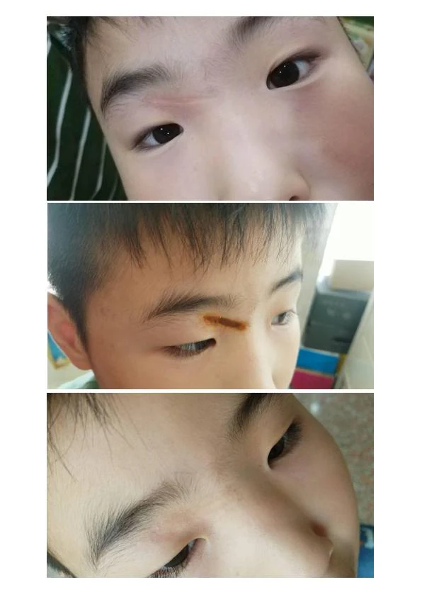 凹陷疤改善阶段记录 13