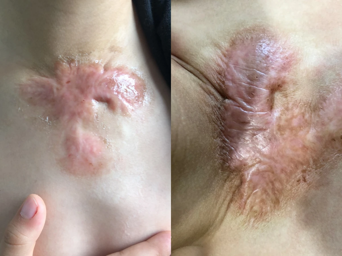 胸前增生疤痕阶段修复