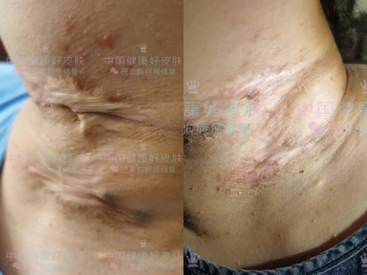 颈部增生疤痕修复记录