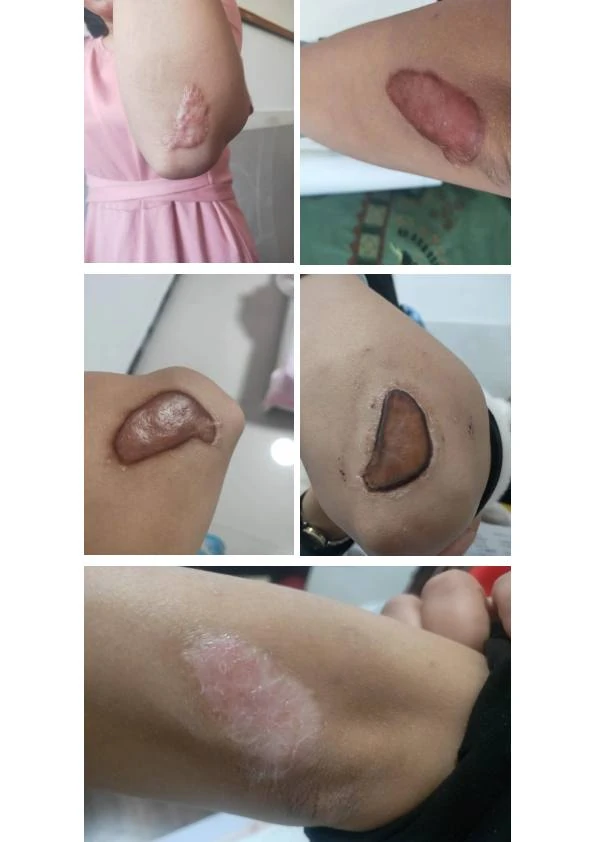 肩部增生疤痕改善对比
