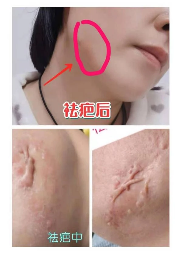 颈部增生疤痕改善记录