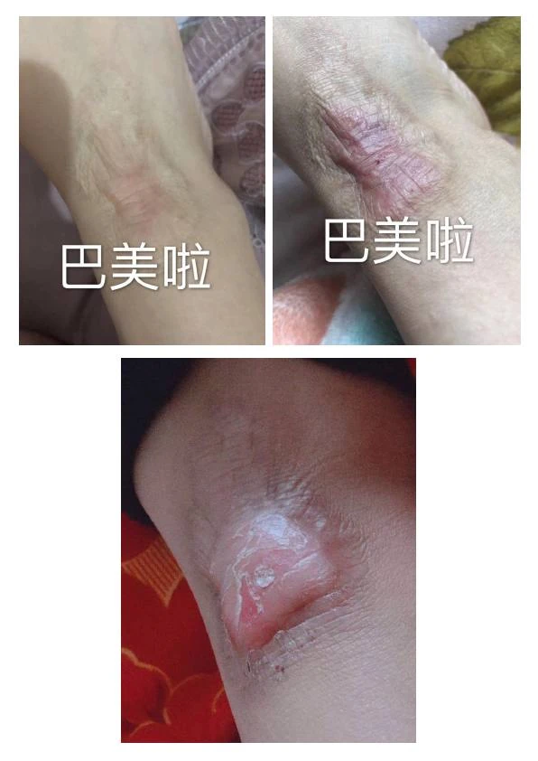 面部增生疤痕阶段修复